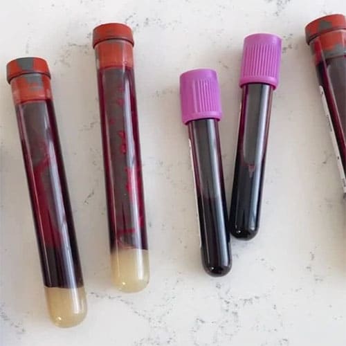 Five blood sample tubes on a white surface; three with red tops show separated plasma, while two with purple tops hold uniformly dark blood—ideal for analyzing vitamin infusion bloodwork.
